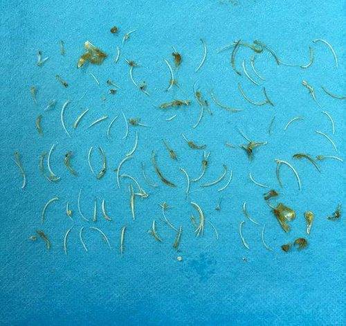 吃兩碗小鯽魚不吐刺直接吞下肚子 一周后發現100根刺扎直腸