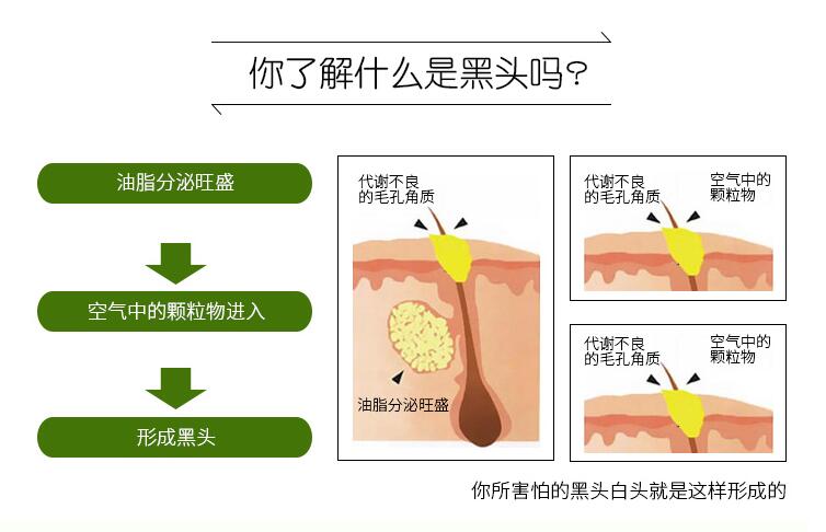 粉刺黑頭怎么去除